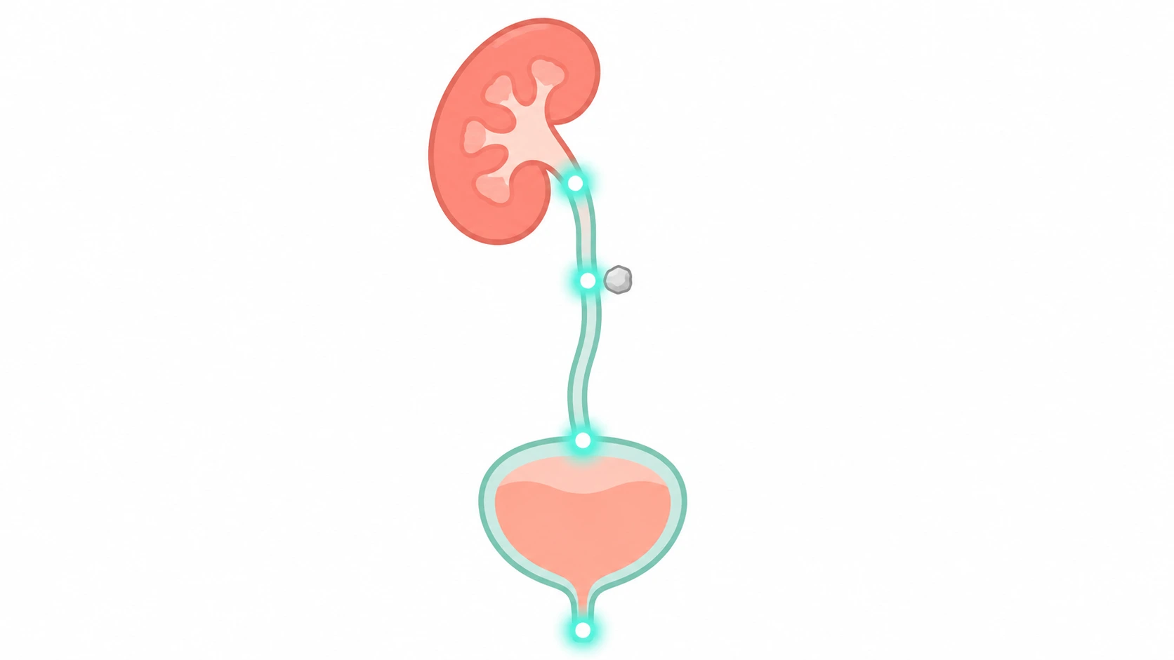 Urinary tract from kidney to urethra with four points marking the stages of passing a kidney stone