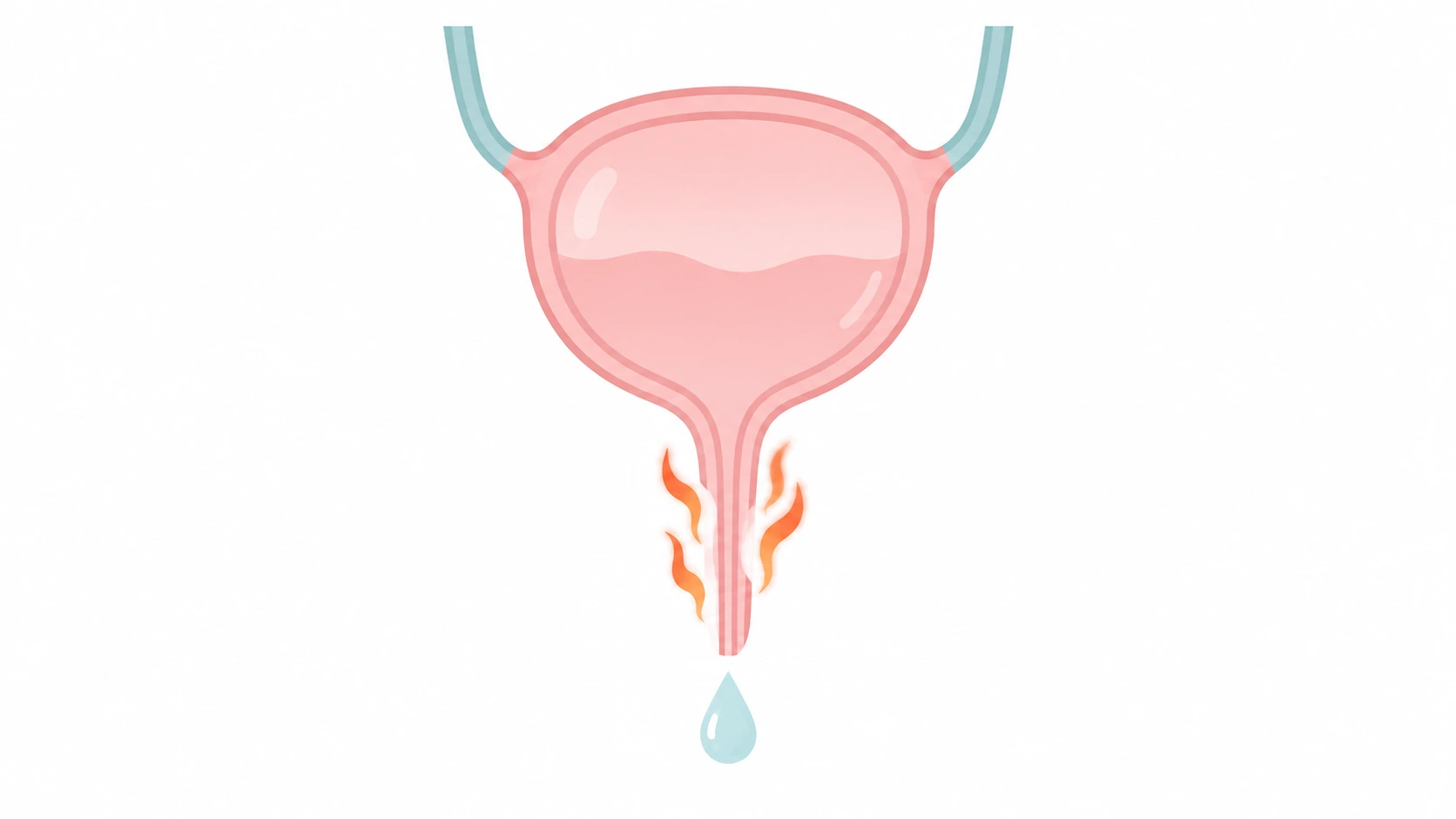 Illustration of the bladder and urethra with small flame marks showing burning during urination